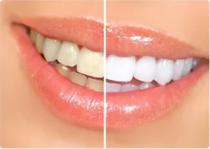 Best Teeth Cleaning in Vancouver