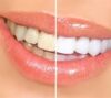 Best Teeth Whitening in Vancouver |